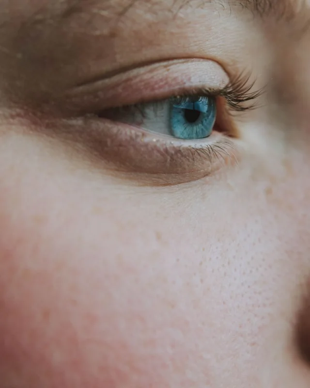 Natural image showing enlarged pores