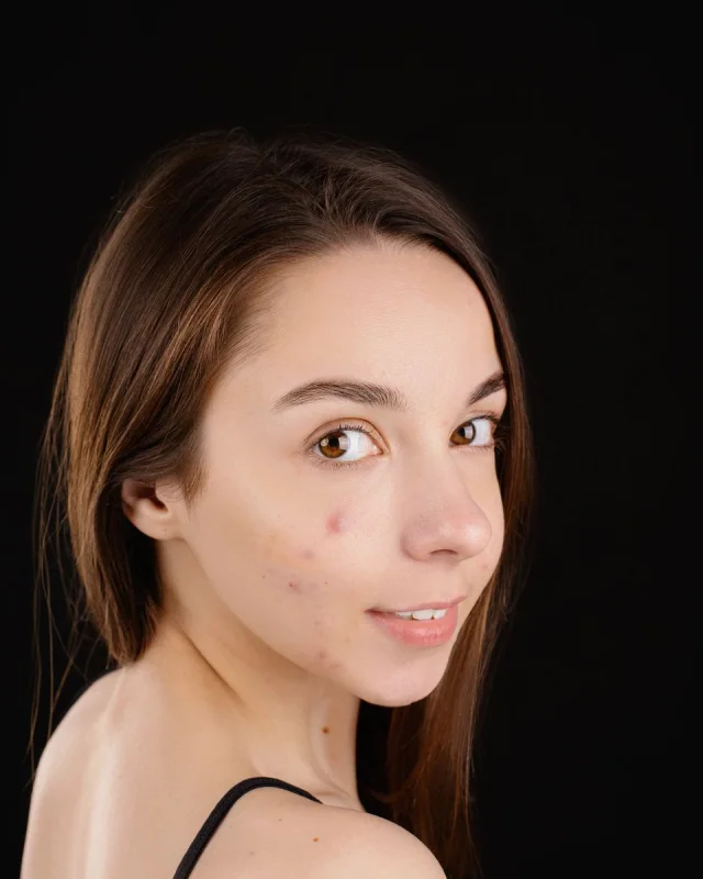 Close-up of acne and active facial breakouts