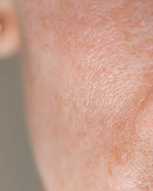 Natural image showing enlarged pores
