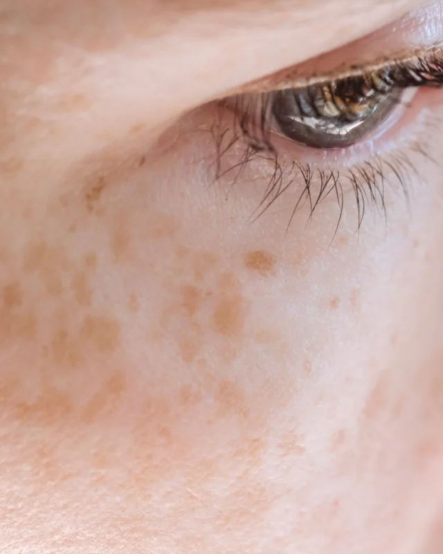 Natural image showing pigmentation & sun damage