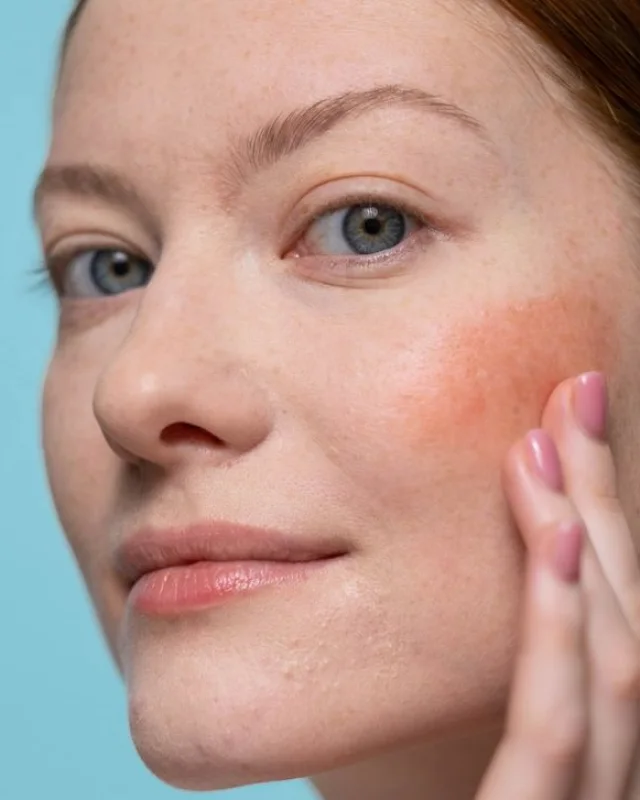 Natural image showing redness & rosacea