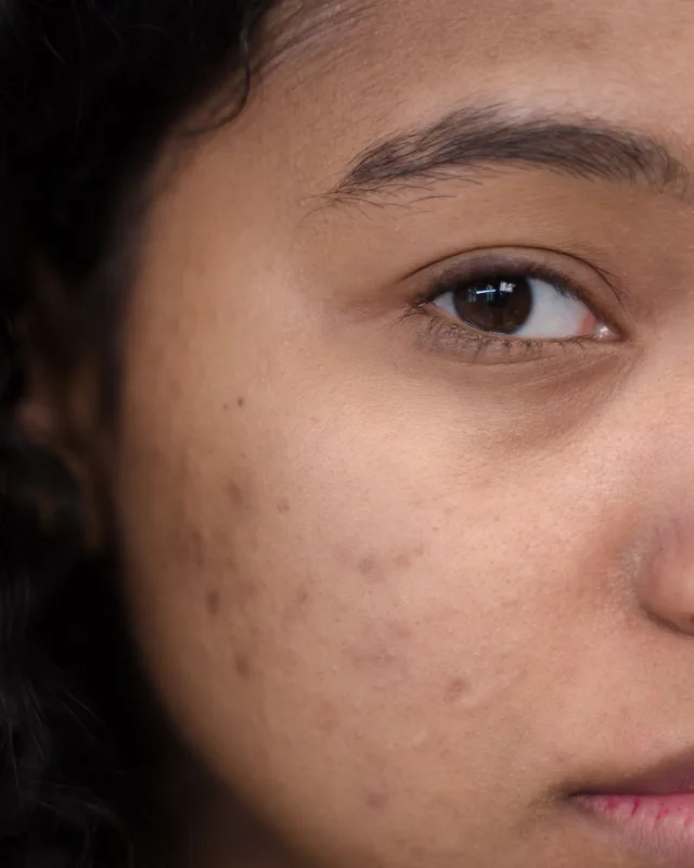 Illustrative close-up of atrophic acne scarring on the cheek — the pitted, indented texture treated by Er:YAG laser scar revision at Rejuvena Bedford