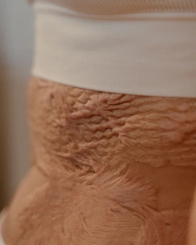 A raised scar shown in close clinical detail