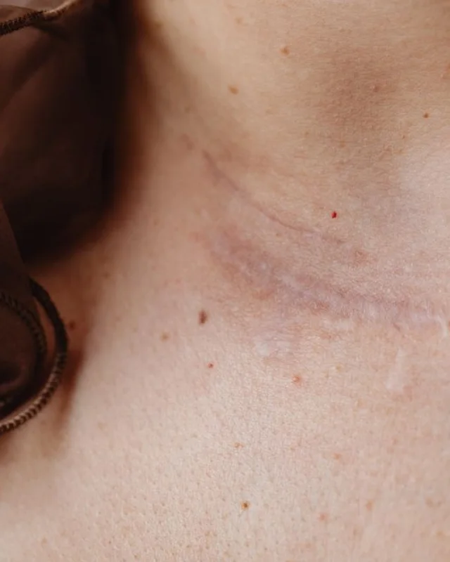 A healed surgical scar shown in close clinical detail