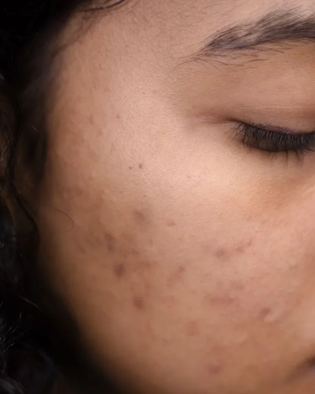 Close-up of symmetrical facial melasma pigmentation