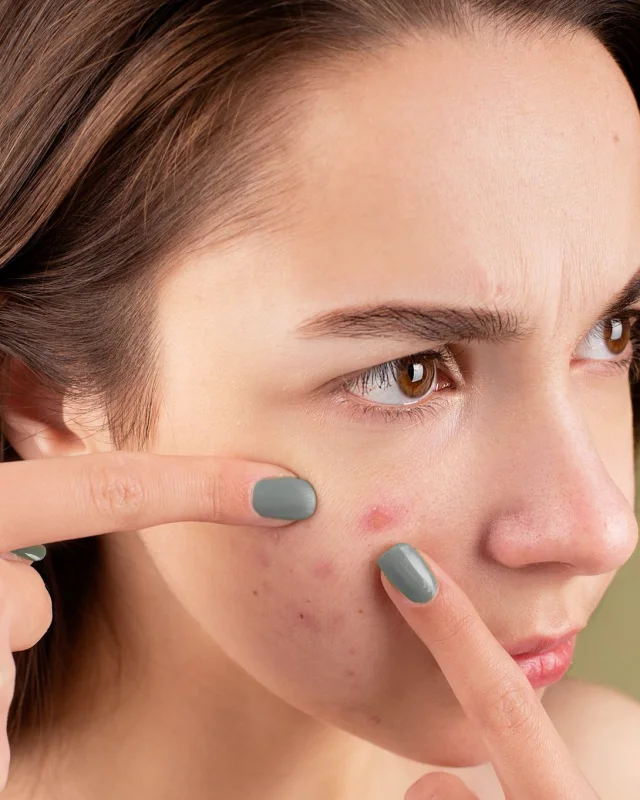Natural image showing post-inflammatory marks