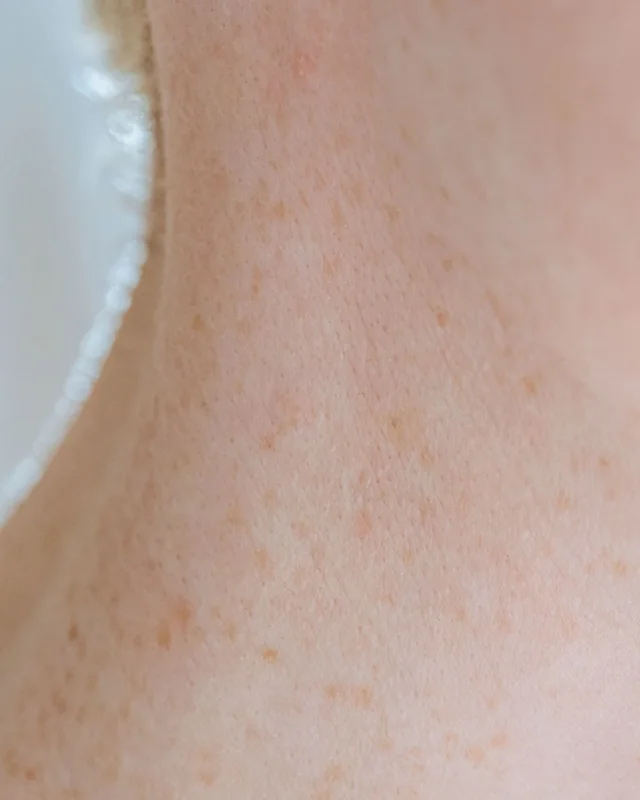 Natural image showing sun damage & dark spots