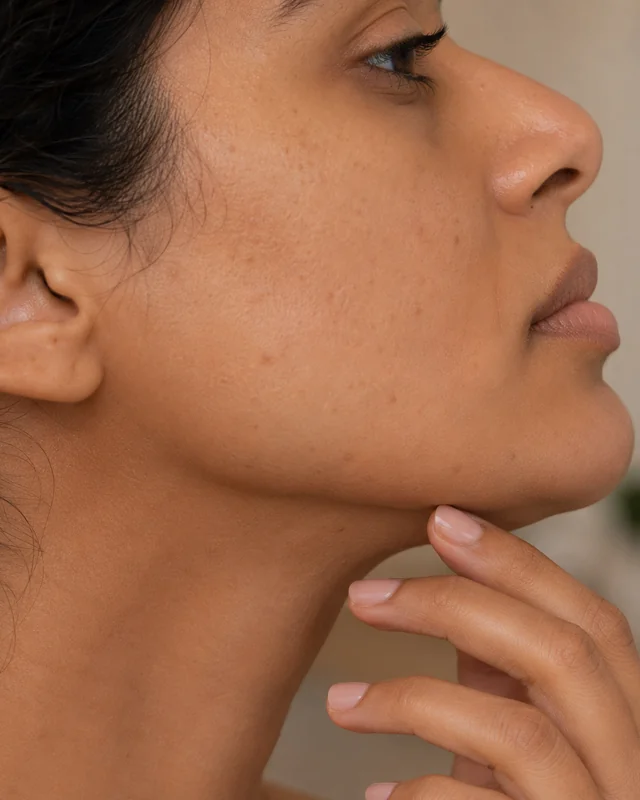 Chin and jawline definition with dermal fillers at Rejuvena, Bedford
