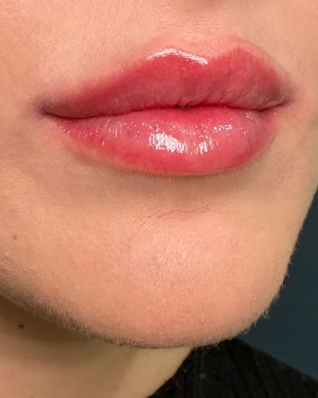 Natural lip enhancement with dermal filler, treated at Rejuvena Clinic, Bedford