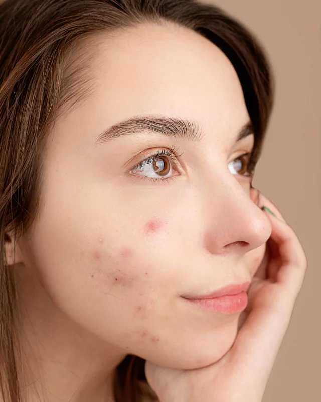 Natural image showing acne & breakouts