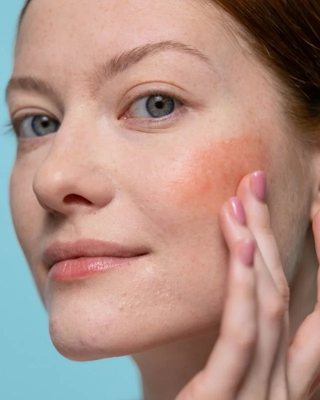 Natural image showing redness & inflammation