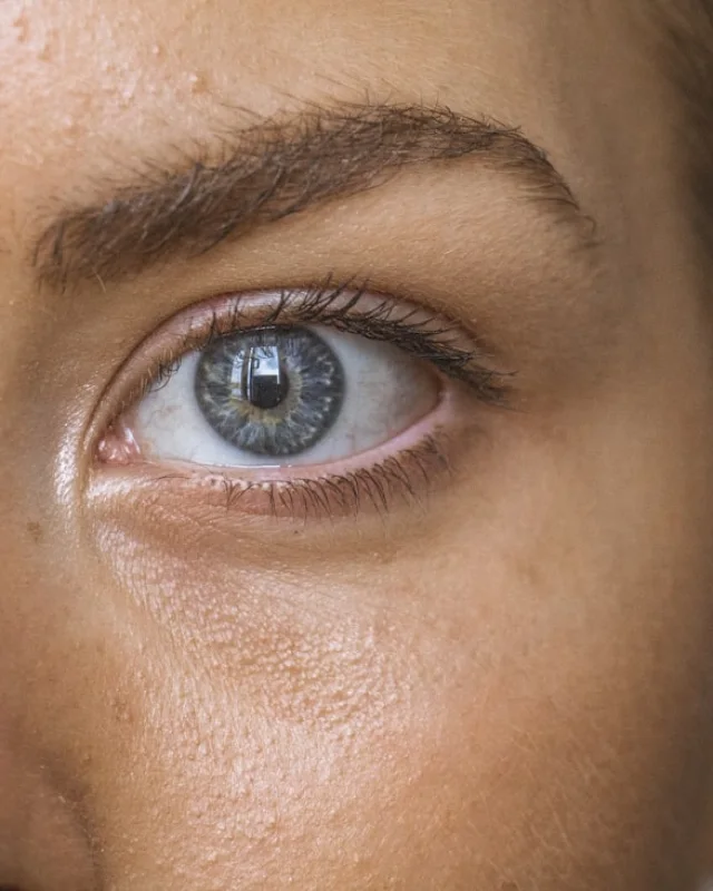 Natural image showing eye-area laxity