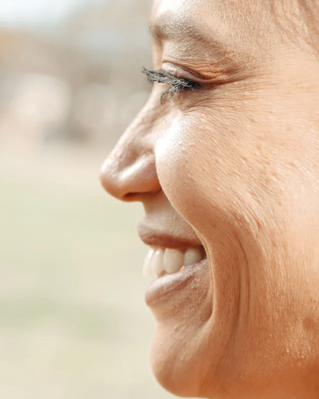 Natural image showing smile & marionette lines