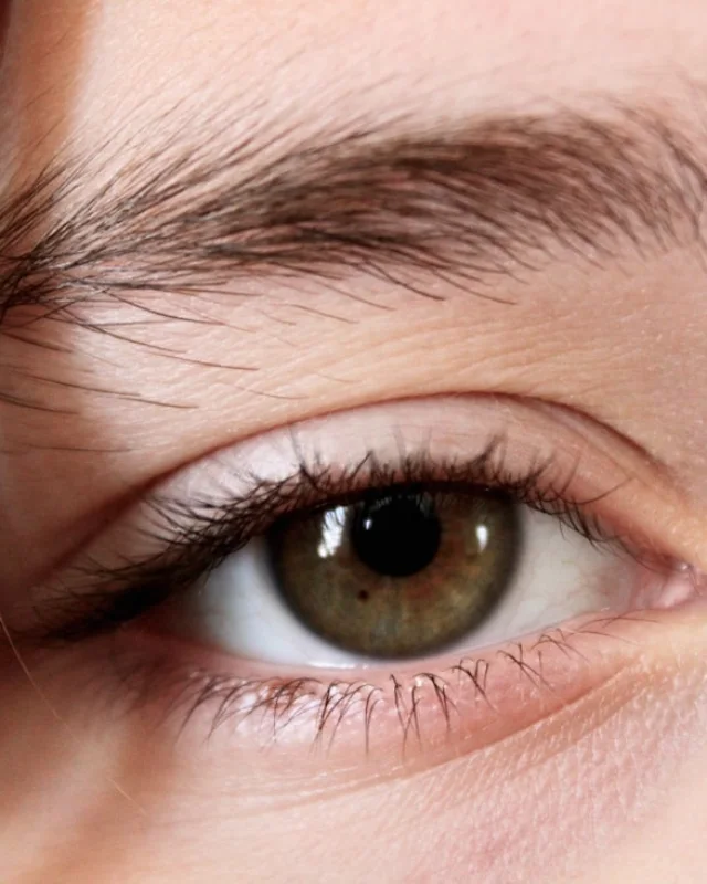 Natural image showing brow & eye-area laxity