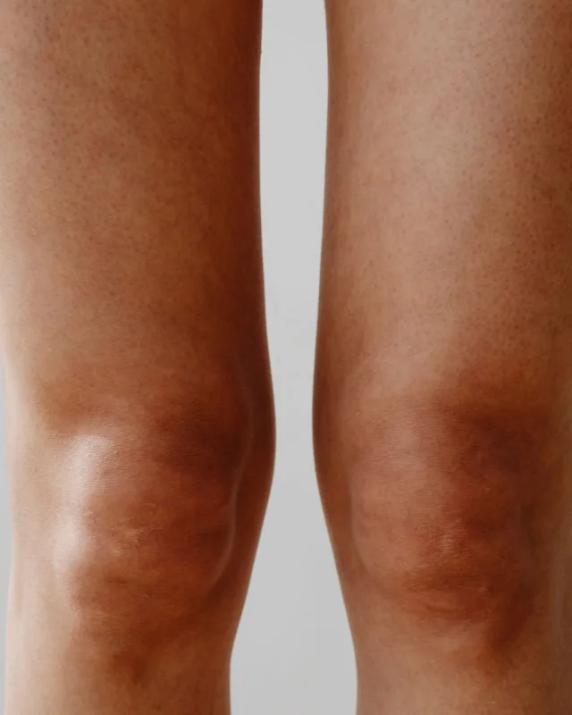 Natural image showing dark elbows & knees