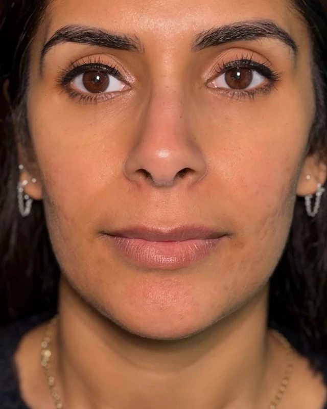 Lip asymmetry, corrected with doctor-led lip filler at Rejuvena, Bedford