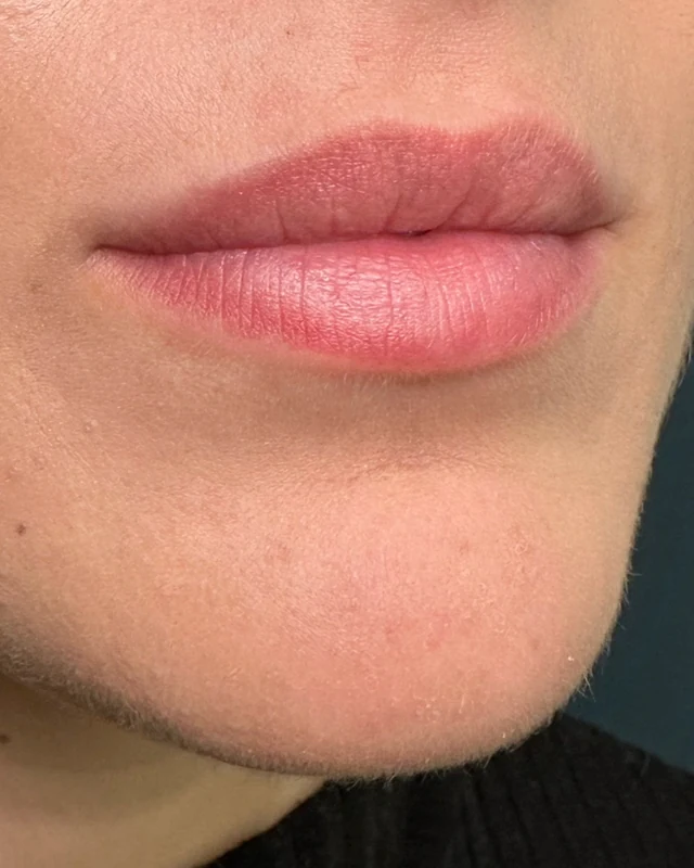 Natural image showing lost lip definition