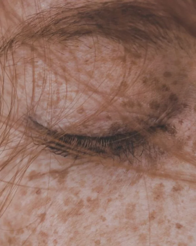 Natural image showing freckles & pigmentation