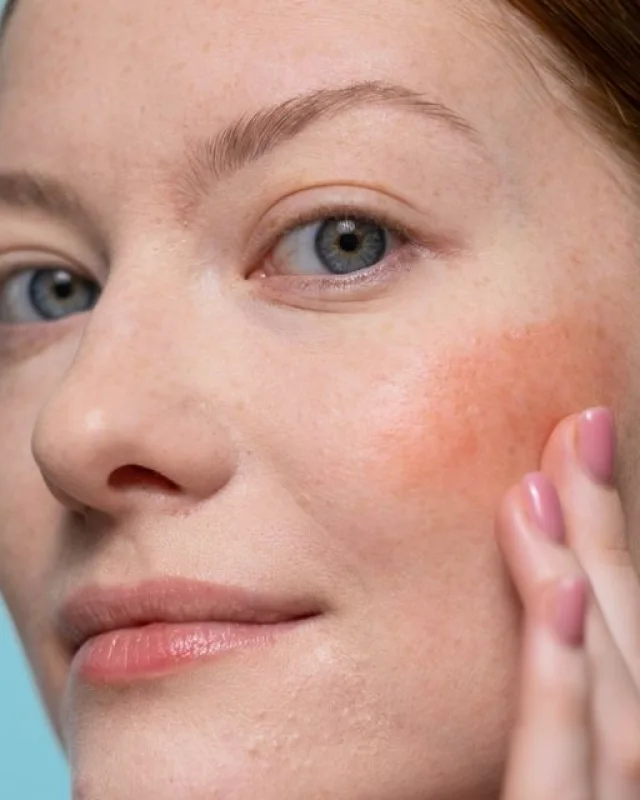 Natural image showing facial redness & rosacea