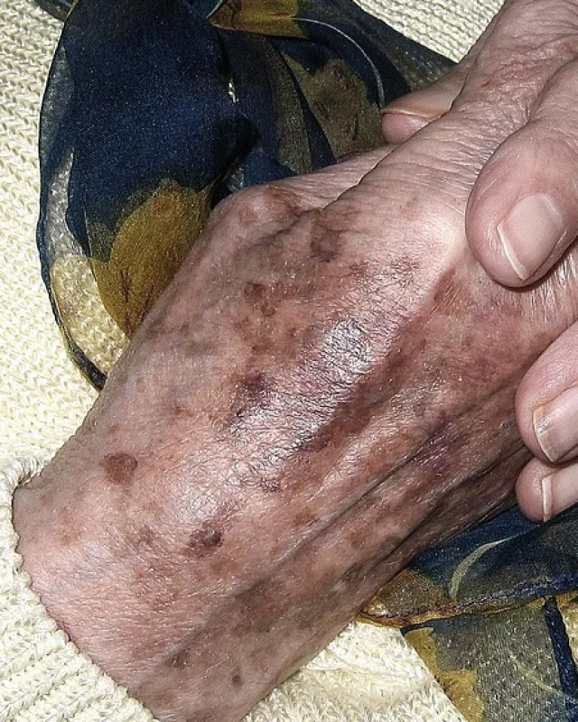 Natural image showing age & sun spots