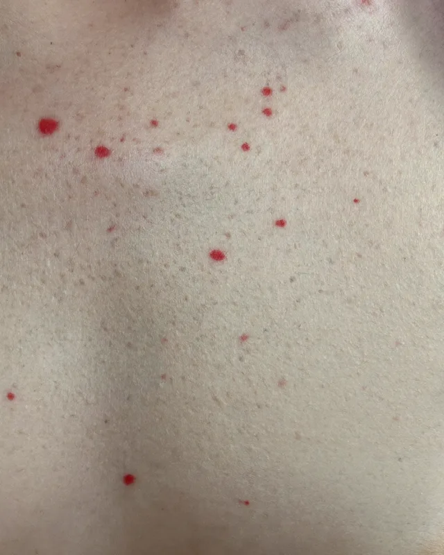 Close clinical view of small red cherry angiomas on natural skin