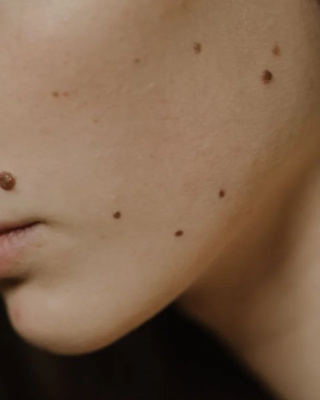 Close clinical view of a benign-looking raised mole