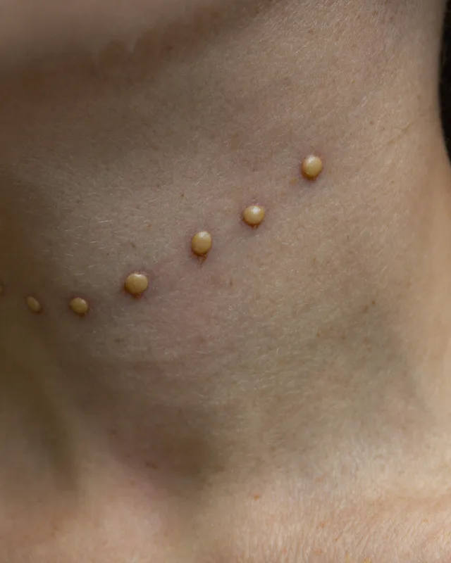 Close clinical view of small raised skin tags