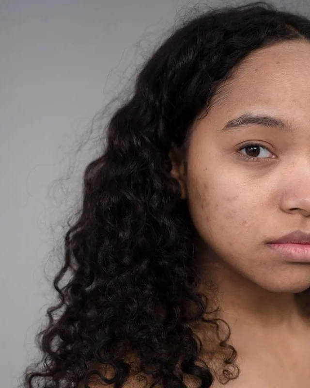 Natural image showing acne scarring