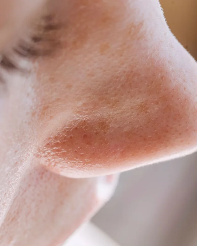 Natural image showing enlarged pores