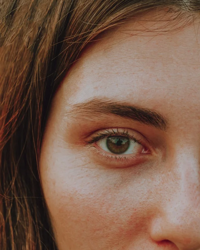Natural image showing pigmentation & freckles