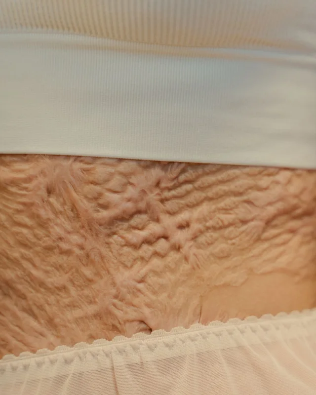 Close-up of stretch marks and changes in skin texture