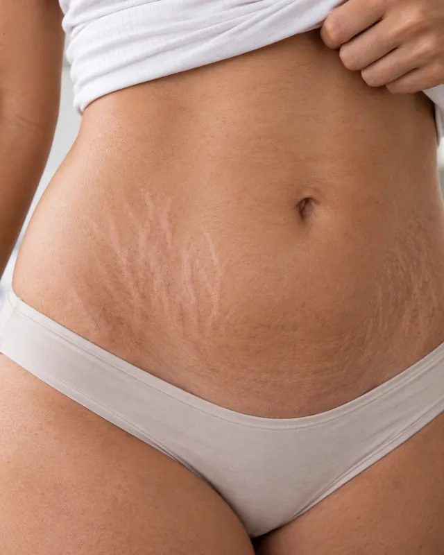 Natural image showing stretch marks