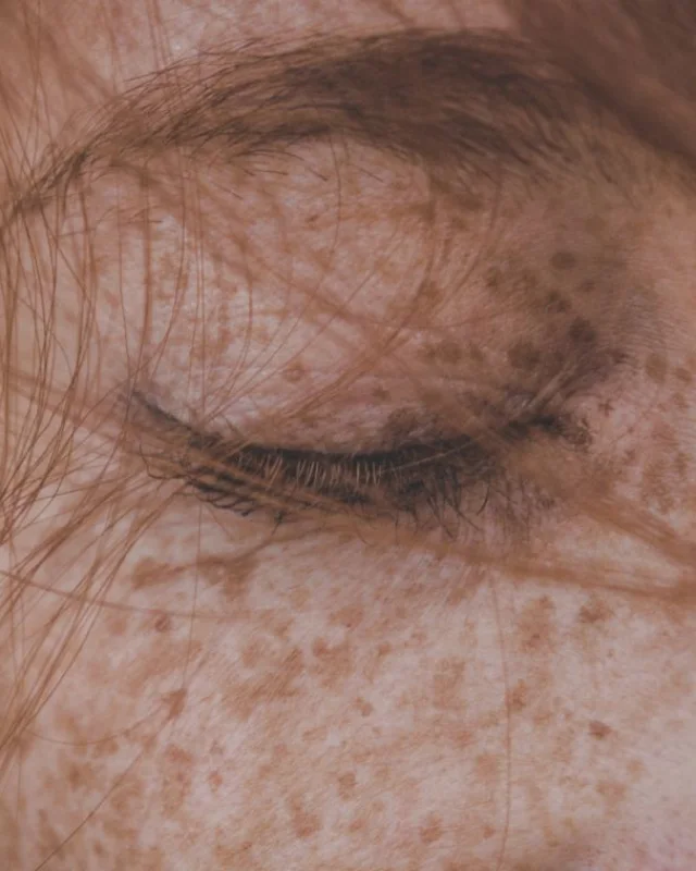 Close-up of facial pigmentation and uneven brown patches