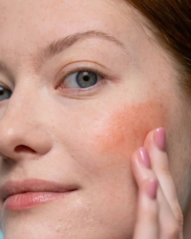 Natural image showing redness