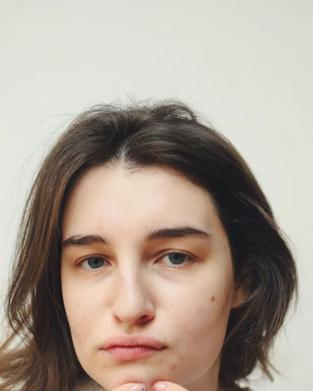 Natural image showing acne scarring