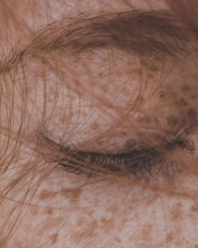 Natural image showing pigmentation & melasma