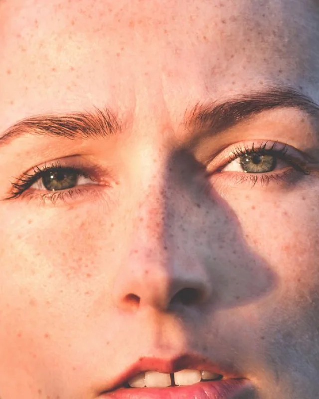 Natural image showing sun damage