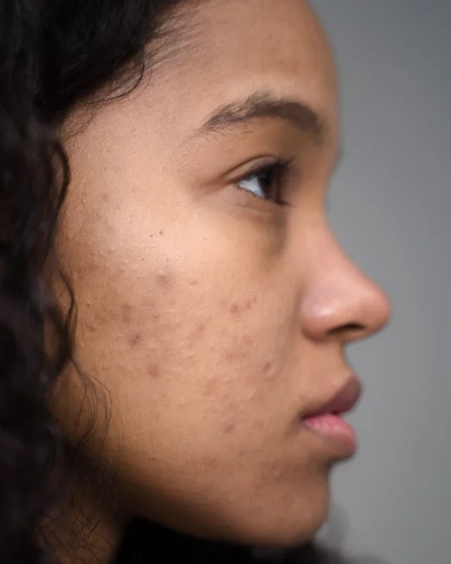 BioRePeel bio-exfoliation treatment used for post-acne marks and mild scarring at Rejuvena Bedford