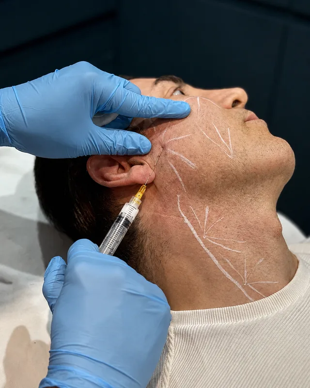 Dr Nick injecting Radiesse along a pre-marked jawline at Rejuvena Clinic in Bedford