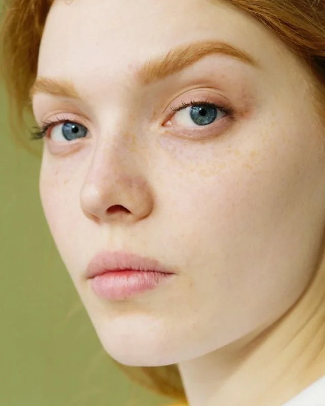 Natural image showing congestion & pores