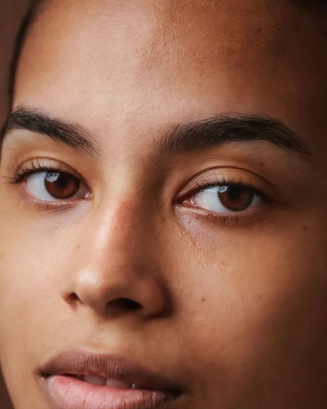 Natural image showing redness & sensitivity