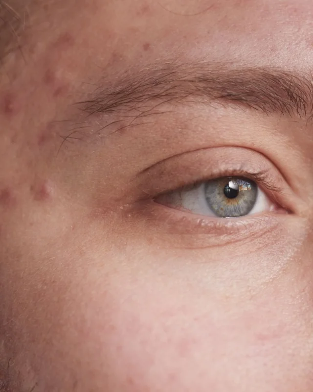 Natural image showing acne scarring