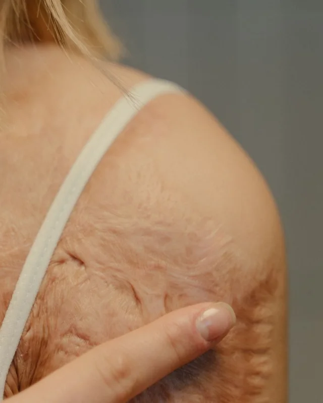 Natural image showing burn scars