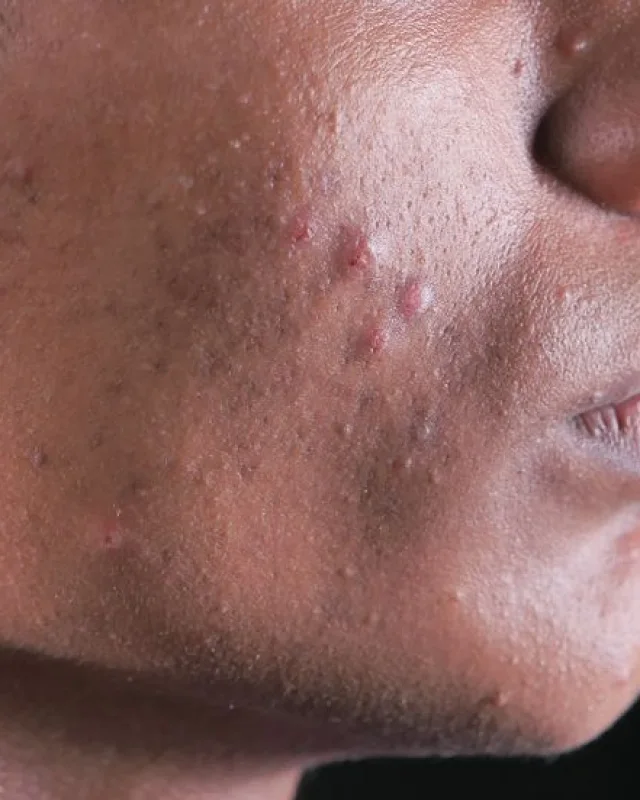 Natural image showing pitted scars