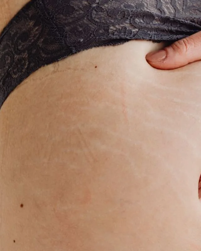 Natural image showing stretch marks