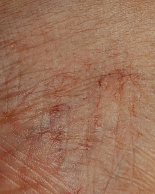 Natural image showing broken capillaries