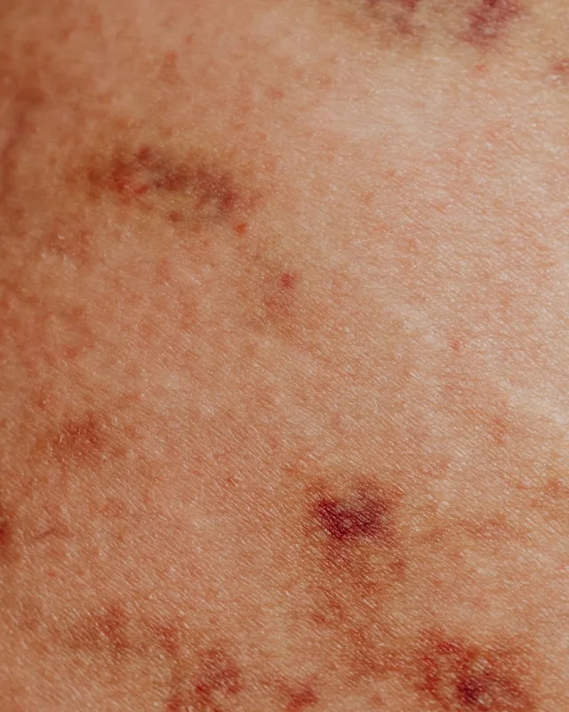 Close-up of visible facial thread veins