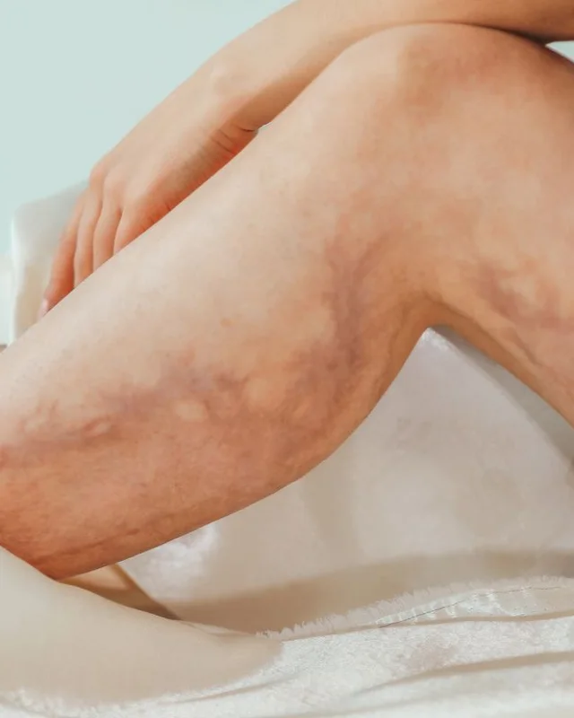 Natural image showing leg thread veins