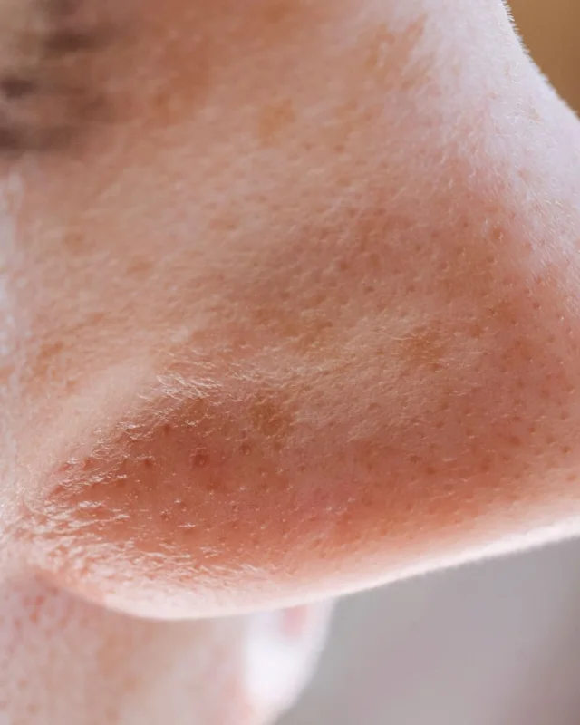 Natural image showing redness around the nose