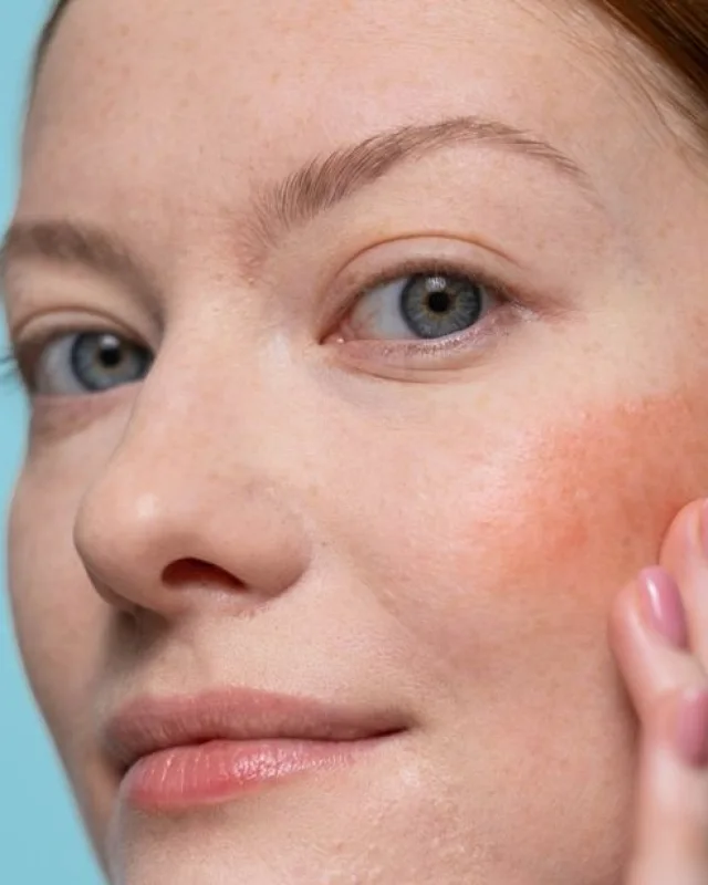 Natural image showing redness & rosacea